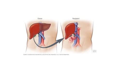 Liver Transplantation